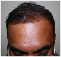 Success Story – FUE Hair Transplant with 1500 grafts