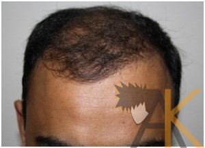 Success Story -FUE Hair Transplant 2000 Grafts Grade 5