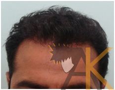 Success Story – Strip Hair Transplant with 3000 Grafts
