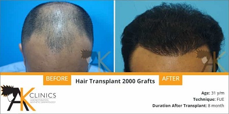 Success Story – 31 Year Old Patient Surgery Result (2000 Grafts With FUE Technique)