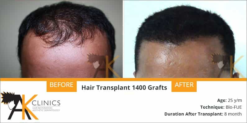 Success Story – 1400 Grafts FUE Hair Transplant Surgery Result after 8 month