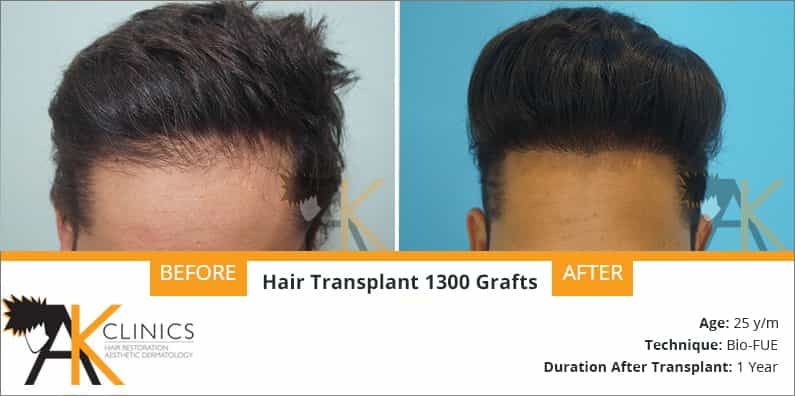 Success Story – 1300 Grafts Bio-FUE Hair Transplant Surgery Result After 1 Year