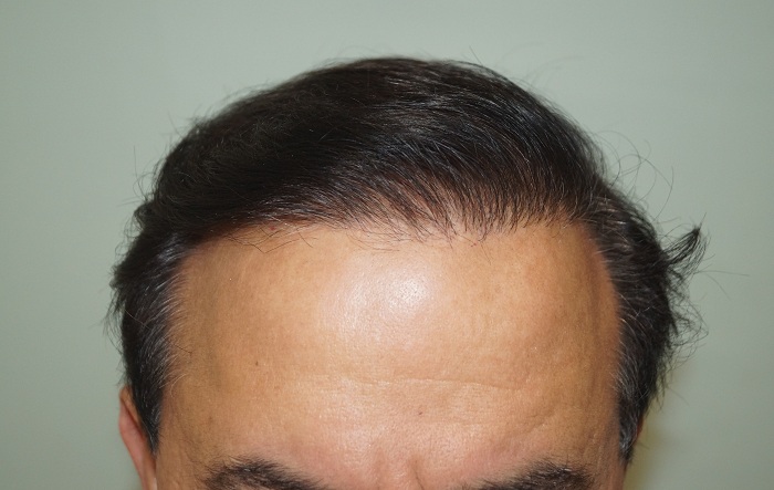 after-1-year-2