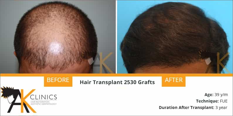 Success Story – 2530 Grafts FUE Hair Transplant Surgery Result after 3 Years