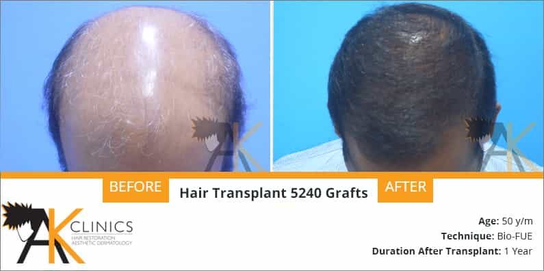 Success Story – 5240 Grafts Body Hair Transplant Surgery Result after 1 years