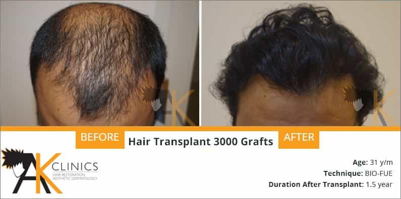 Success Story – 3000 Grafts BIO-FUE Hair Transplant Surgery Result after 1.5 years