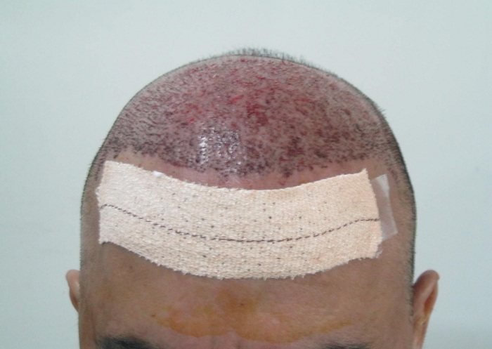 immidate-post-op-23