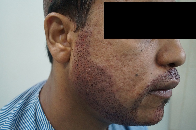 Imm Post Op 13