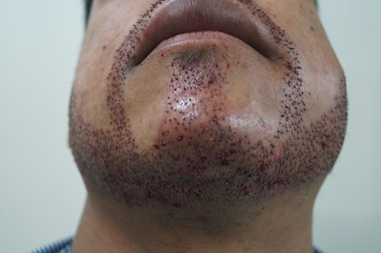 Imm Post Op 14