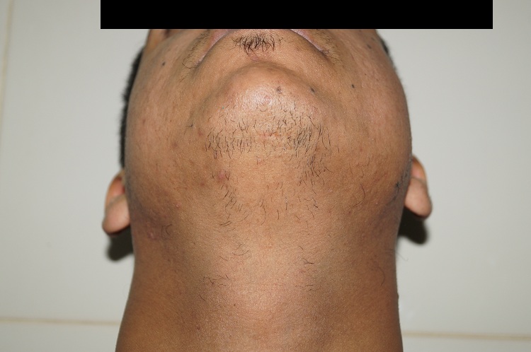 Pre Op 44