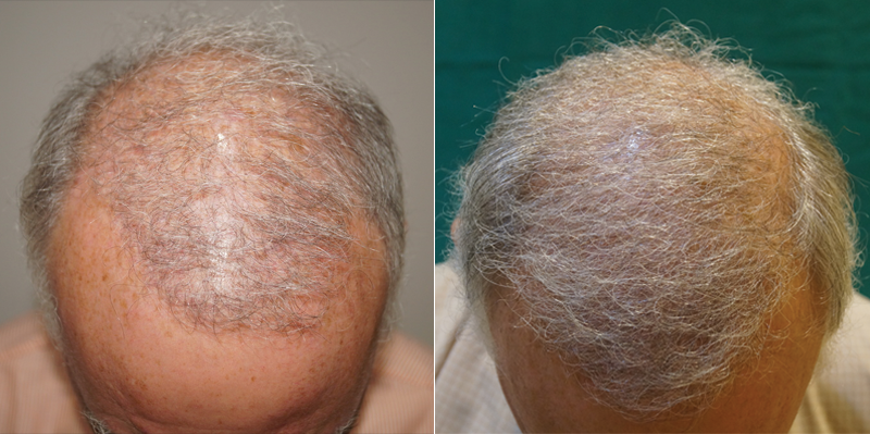 63 Year Old Australian Patient 4730 Grafts Body Hair Transplant