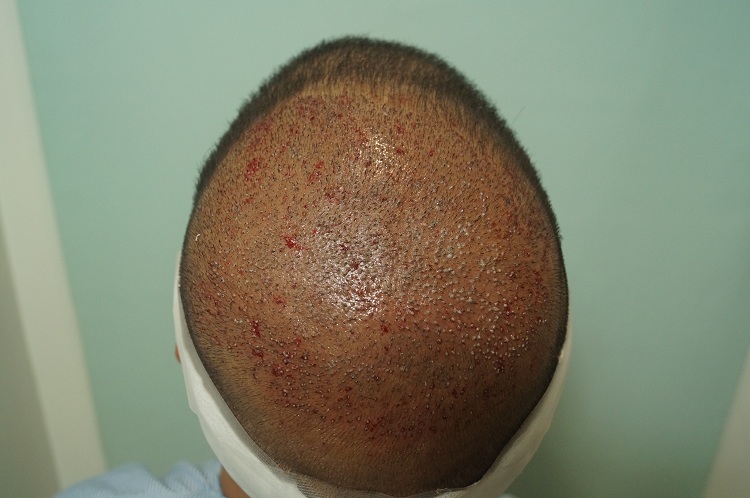 2nd Imm Post Op (2)