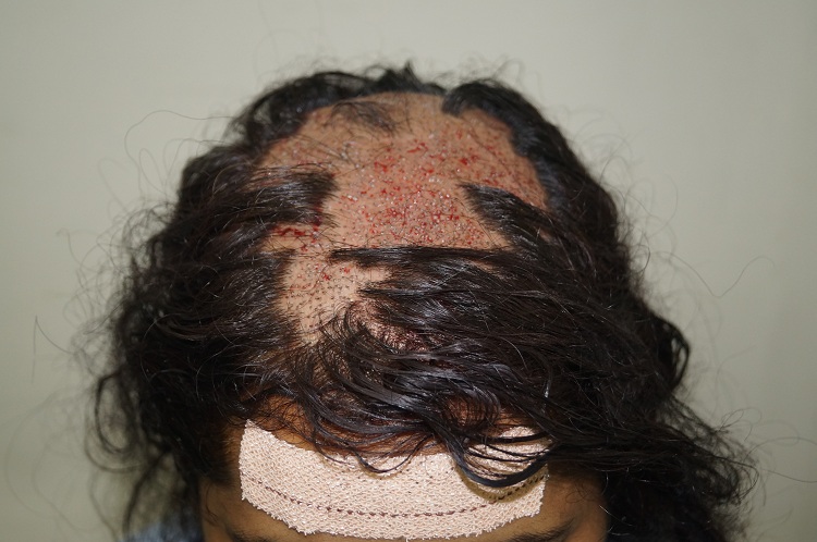Imm Post Op (2)