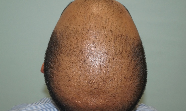 Pre Op (1)3 FS
