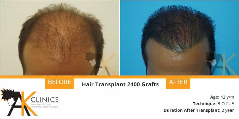 Hair Transplant Result of 2400 Grafts With Bio Fue Technique
