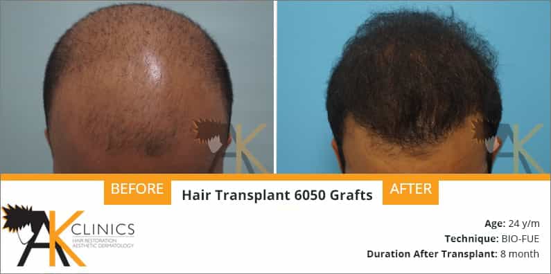 Hair Transplant Result After 8 Months by BIO-FUE Technique