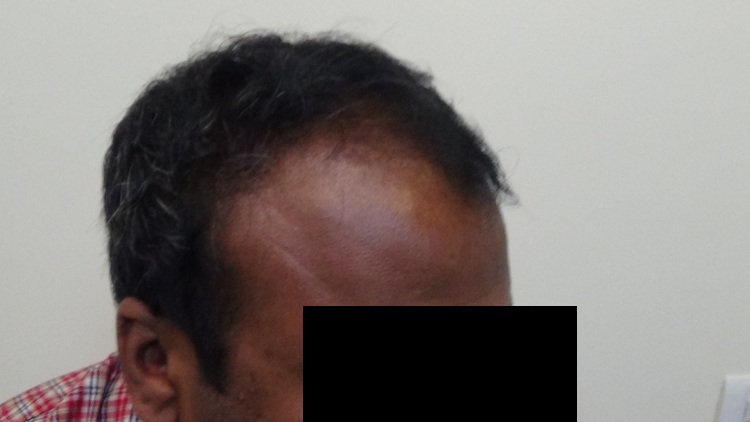 Before (2)