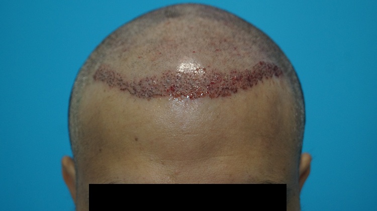 Imm Post Op (2)