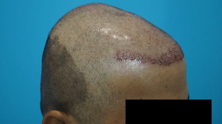 Imm Post Op (4)