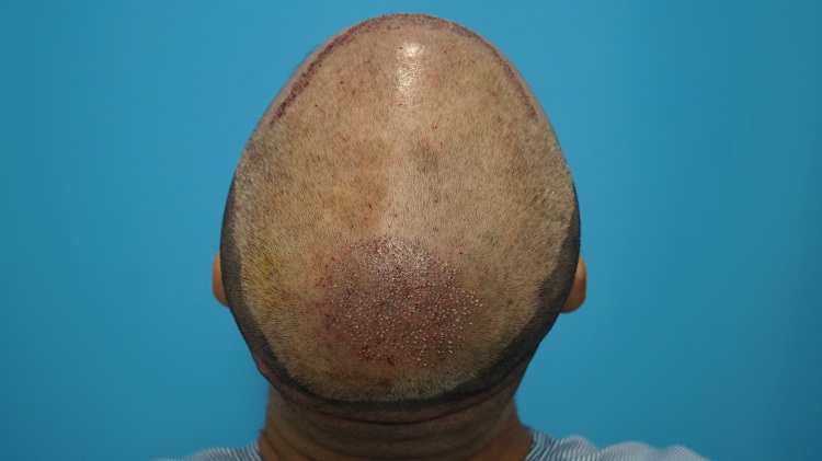 Imm Post Op (5)