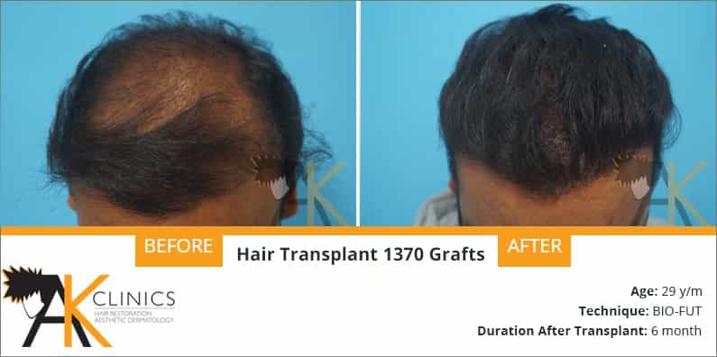 Hair Transplant Result – 1370 Grafts – BIO FUT Technique
