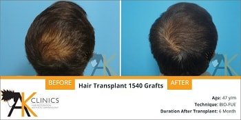 NW Grade 3V Patient Result After 5 Months