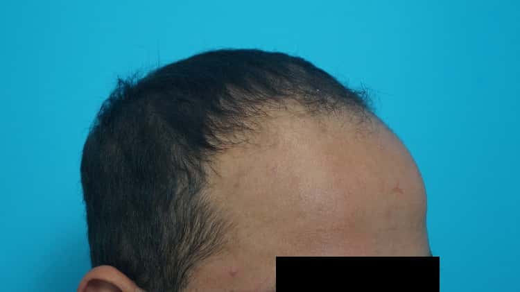 Preop (4)-min