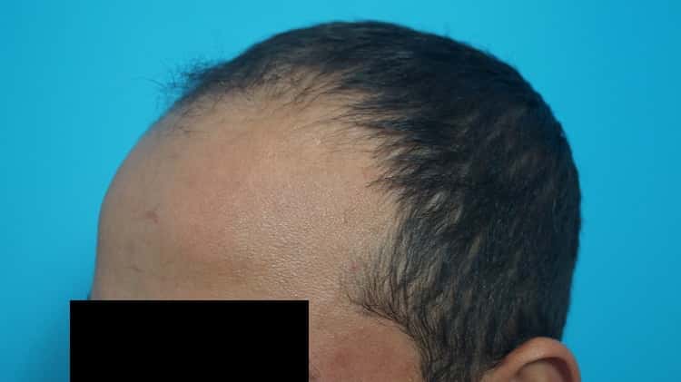 Preop (5)-min