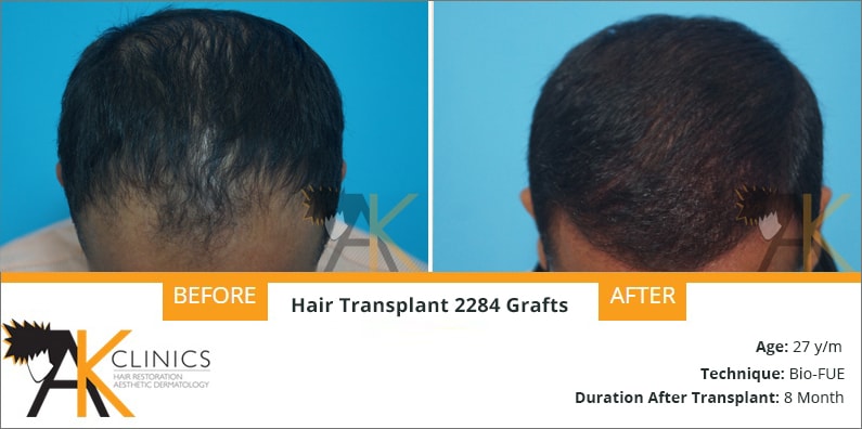 BIO FUE Hair Transplant Result After 8 Months – 2284 Grafts