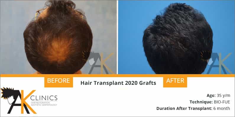 2020 Grafts Hair Transplant Surgery Result after 6 Months