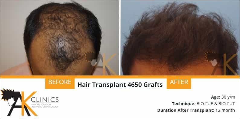 4650 Grafts With FUE+FUE Technique Result After 1 Year
