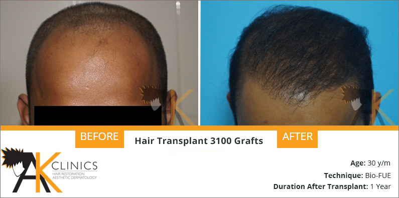Hair Transplant Result – 3100 Grafts BIO FUE Technique