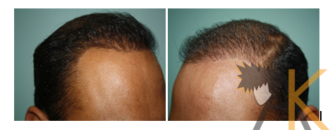 Surgery after result 