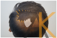 Before Hair Transplant