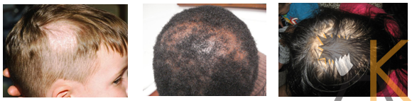 hairtransplanthd