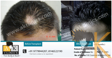 hairtransplanthd