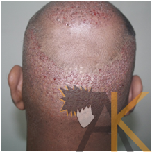 Immediate Post op after 2nd session back