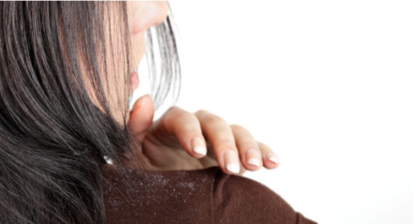 Hair Dandruff 