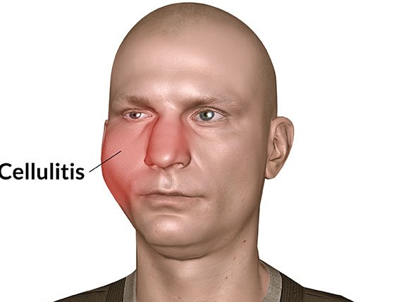cellulitis