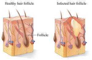 folliculitis