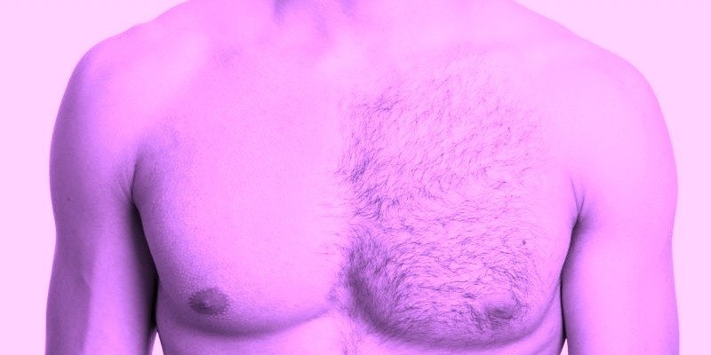 Laser Hair Removal in Men
