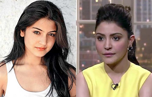 Anushka Sharma lips surgery pics