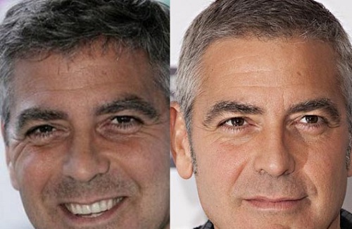 George Clooney surgery pics