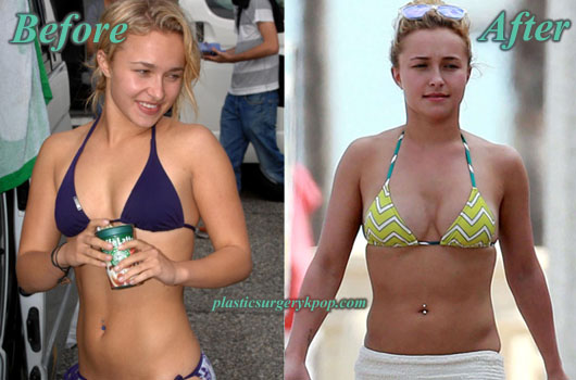 HaydenPanettierePlasticSurgery