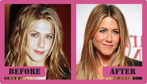 Jennifer-Aniston plastic surgery photos