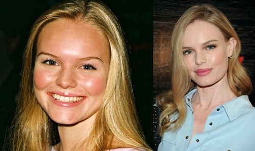 Kate-Bosworth cosmetic surgery