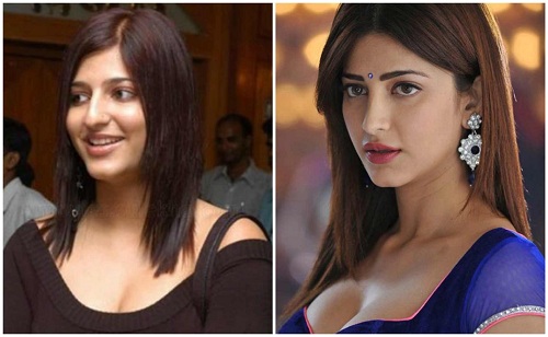 Shruti-Hassan before and after surgery pics plastic surgery