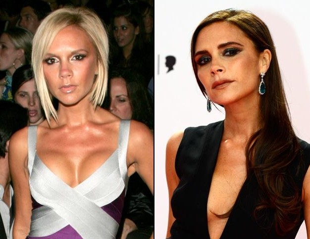Victoria-Beckham-Breast-Implants