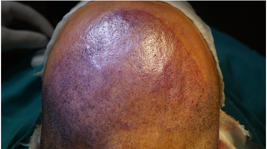 Slits treated with Methylene blue to increase the visibility