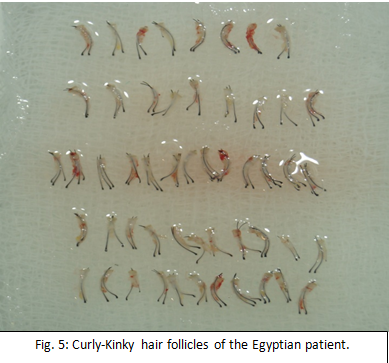 Curly-Kinky hair follicles of the Egyptian patient